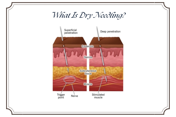 What Is Dry Needling