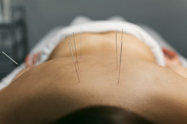 Dry Needling South East Melbourne