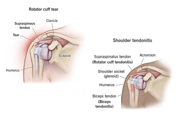 Rotator Cuff Tear