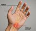 Carpal tunnel syndrome