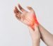 Carpal-tunnel- syndrome