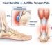 Heel Bursitis vs Achilles Tendon Pain