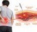 Recurring Muscle Knots: Can Dry Needling Help Relieve Muscle Pain and Tension