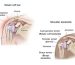 Rotator Cuff Tear